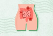 Розуміння Запору: Причини, Полегшення та Профілактика