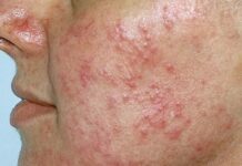 Розацеа та схожі стани: чіткий посібник з проблем шкіри